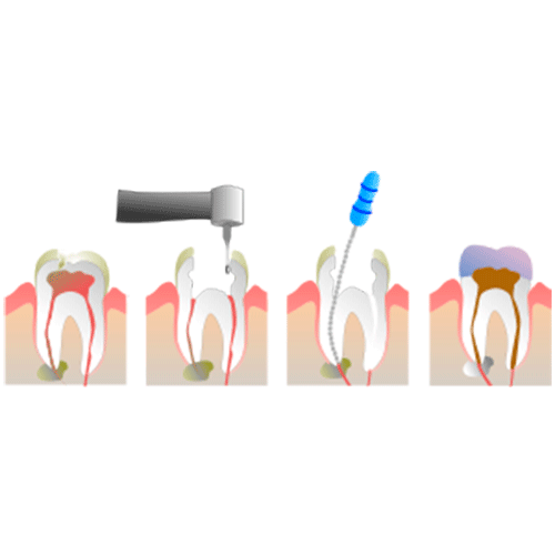 endodoncia