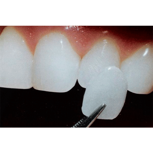 colocación de una corona dental