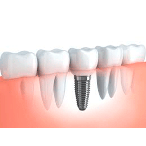 implante dental