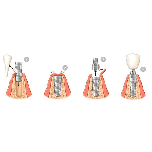 proceso para realizar un implante dental