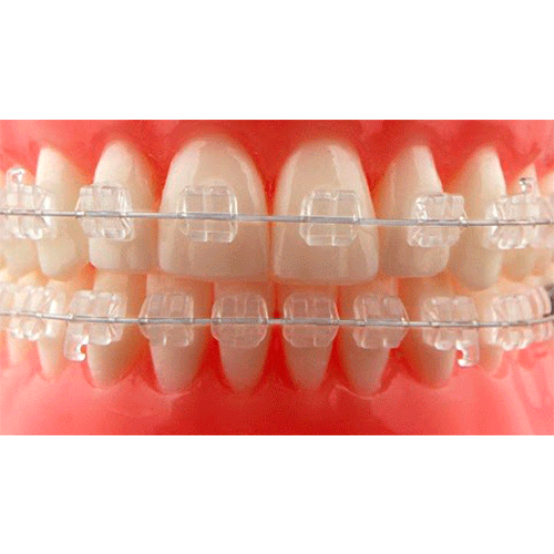 sonrisa con brackets estéticos