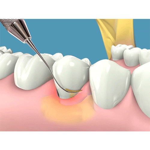 limpieza de sarro y placa bacteriana