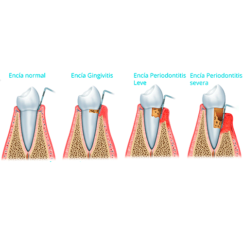 diferencia entre una encía normal, una con gingivitis, una con periodontitis leve y con periodontitis severa